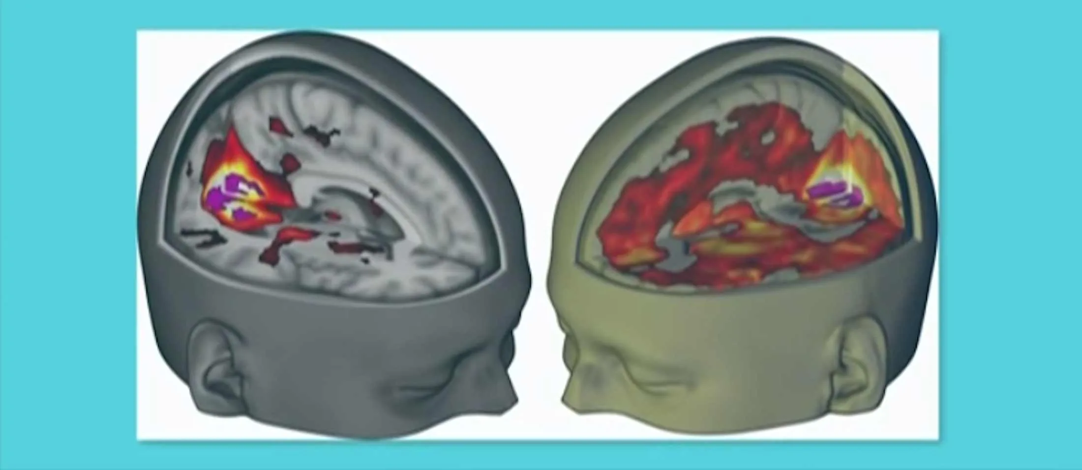 LSD, addiction, depression, rehab, detox,